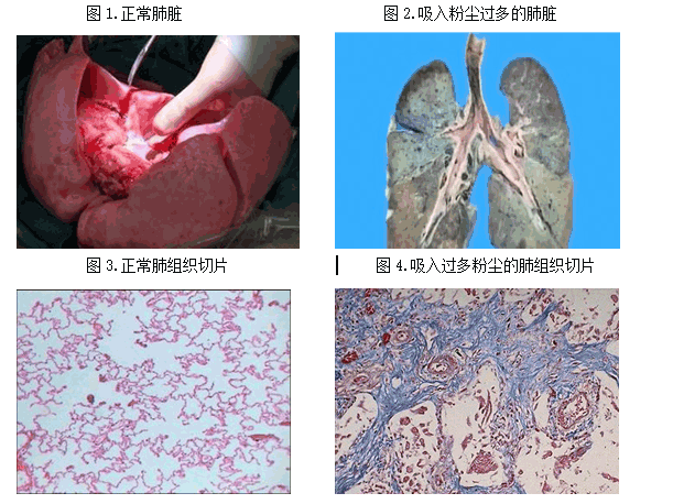 圖1為正常肺臟組織,為嫩粉色的疏鬆組織.
